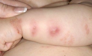 Skin rash is a symptom of infection with the West Nile virus. Credit: medicalpicturesinfo.com